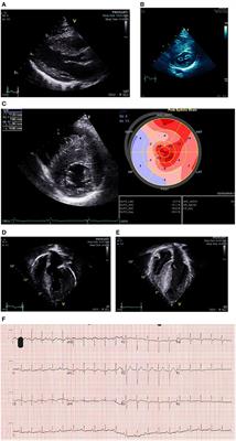 Childhood Hypertrophic Cardiomyopathy: A Disease of the Cardiac Sarcomere